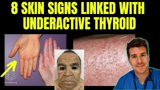 Doctor explains 8 SKIN SIGNS linked with HYPOTHYROIDISM aka underactive thyroid [upl. by Aneej372]