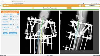 Correcting Leg Deformity Full Surgical Planning Explained with XRays [upl. by Chaunce667]