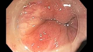 Anal canal  Cancer  Healed after chemoradiation [upl. by Sidras]