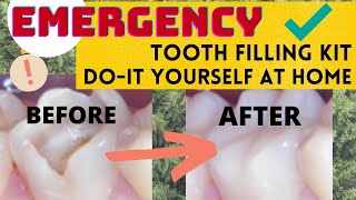 Emergency Tooth Filling Kit DIY at Home Easy Fix Solution [upl. by Paris]