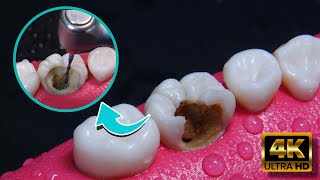 INCREIBLE reconstrucción de diente dañado por caries Endodoncia en 4K [upl. by Nylarad]