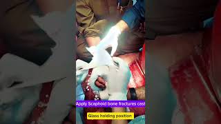 Pop cast for scaphoid bone fracture orthopedics shortvideo [upl. by Larret]