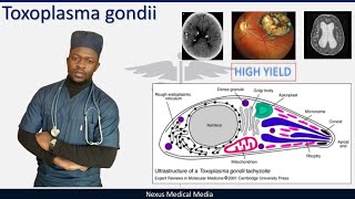 Toxoplasma gondii  Toxoplasmosis clinical features diagnosis and treatment [upl. by Adelle]