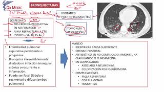 4 BRONQUIECTASIAS [upl. by Narrad]