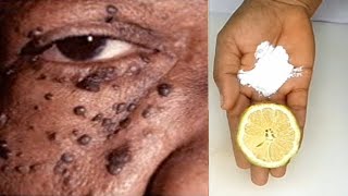 DIY skin tag removal in 3 days skin tag removal challenge natural remedy [upl. by Perzan605]