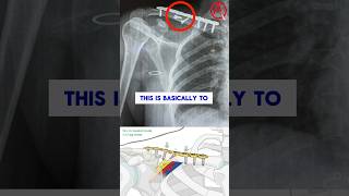 Clavicle Fracture COLLARBONE [upl. by Kurys]