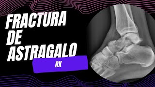 Fractura de astrágalo [upl. by Mayor11]