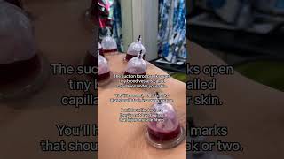 Hijama benefits in islam amp science [upl. by Yttel443]