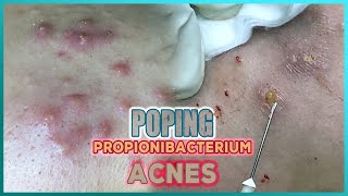 Big Cystic Acne Blackheads Extraction Blackheads amp Milia Whiteheads Removal Pimple Popping [upl. by Mccartan710]