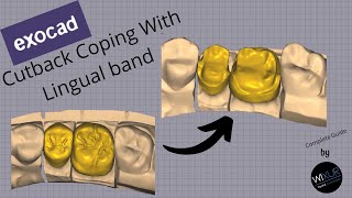 Cutback Coping With Lingual Band Exocad [upl. by Asta]