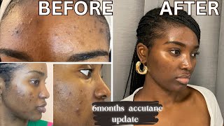 GETTING RID OF ACNE amp HYPERPIGMENTATION  6 MONTHS ACCUTANE UPDATE  ACCUTANE JOURNEY [upl. by Kenny]