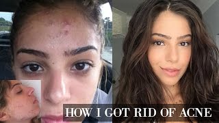 HOW I CURED MY ACNE Cystic Digestive Hormonal  Organic Olivia [upl. by Gallenz]