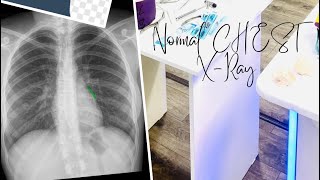 Chest Xray normal view what is chest Xray🤔 [upl. by Inaleon726]