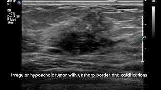 Breast ultrasound  cancer [upl. by Narrat]