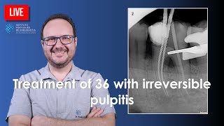 🔴 Treatment of 36 with irreversible pulpitis  part 1 [upl. by Erastes68]