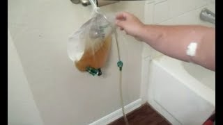 How Drain Urinary CATHETER BAG Release Pour Empty Remove Leg Urine Foley BARD Bardia Night Drainage [upl. by Krusche168]