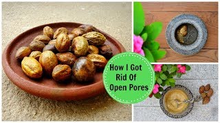 How I Got Rid Of Large OPEN PORES Permanently amp Naturally Using an Ayurvedic Remedy [upl. by Emmi]