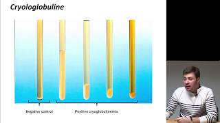 Vascularite cryoglobulinémique [upl. by Indira]