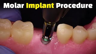 Step by Step Dental Implant Procedure  Back Molar [upl. by Solley]