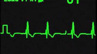 Right Bundle Branch Block  ECG Simulator  Arrhythmia Simulator [upl. by Nesyrb]