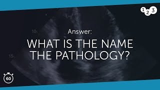 60 Seconds of Echo Teaching Answer What is the name of the pathology [upl. by West]