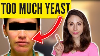 6 SIGNS OF TOO MUCH YEAST SKIN DrDrayzday [upl. by Ellenej]