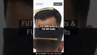 Best Hair Transplant Results by Dr Suneet Soni at Medispa Hair Transplant [upl. by Torrance274]