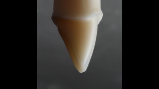 All Ceramic Crown Preparation for Emax and Zirconia [upl. by Ahsaz]