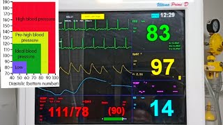 ICU Multipara Monitor In Hindi  ICU Monitor Full Explain Hindi  Dr Advise [upl. by Coriss]