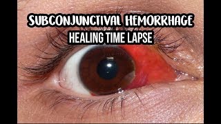 14 Days Healing Time Lapse Broken Blood Vessel in Eye Subconjunctival Hemorrhage [upl. by Ainniz]