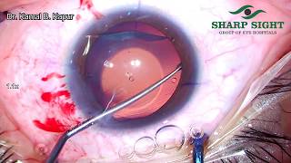 Visian ICL implant insertion problem management [upl. by Ahsemac85]