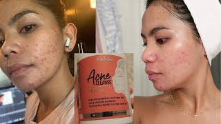 Kallistia Acne Cleanse Skin Care for 30 Days Honest Review Hormonal Acne  My Skin Journey [upl. by Salvador665]