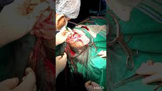 Craniotomy Procedure mbbsdairies mbbs aiimsdelhi biharmedicalcollege medico doctor [upl. by Matelda]