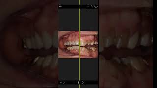 Invisalign Time Lapse Video [upl. by Ahsiym44]