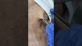 You MUST Watch this Skin Tag Removal skintagremoval skintags [upl. by Suckram817]