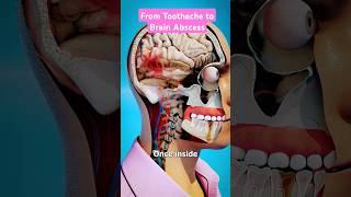 From Toothache to Brain Abscess shorts shortsfeed [upl. by Cerveny]