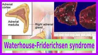 Waterhouse Friderichsen syndrome [upl. by Nnaaras]