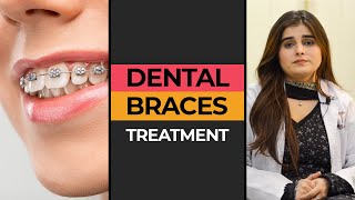 Teeth Braces Treatment in Karachi  HASH CLINICS [upl. by Schilling]