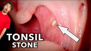 Tonsil Stones Removal Compilation  What Are Tonsil Stones [upl. by Anerak]