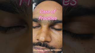 Freckles Laser removalDr Alamins Skin Hair amp Laser Clinic near dhubri medical college6901855020 [upl. by Ecitsuj735]