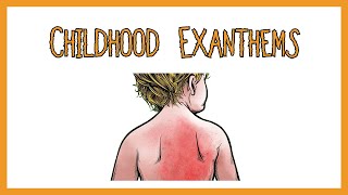 Childhood Exanthems rash [upl. by Ecirtram]