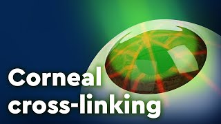 Corneal Collagen Crosslinking and Keratoconus Treatment [upl. by Aibat754]