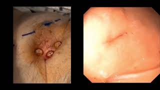 How to perform direct percutaneous gastrostomy with Tfastener gastropexy using endoscopic guidance [upl. by Lanza1]