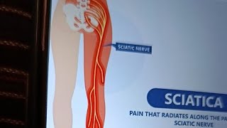 sciatica streching nerve exercise amp Sciatica pain relief exercise [upl. by Dyer720]