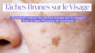 Tâches brunes sur le visage hyperpigmentation de la peau  retrait avec le laser picosure cynosure [upl. by Nimajeb]