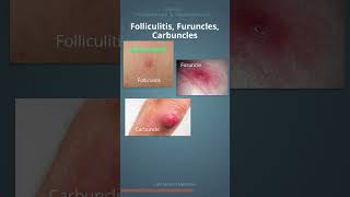 Folliculitis Furuncles and Carbuncles  Do you know the difference shorts [upl. by Eltsyrhc]