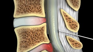 Epidural Steroid Injections [upl. by Ellemac]