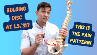 L5S1 Bulging Disc Pain Pattern Explained [upl. by Kwok]