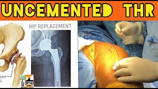 Uncemented Total Hip Replacement surgery step by step  modified Hardinge  Lateral approach to Hip [upl. by Sigmund568]