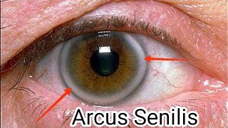 Arcus senilis cornea senilis [upl. by Evie987]